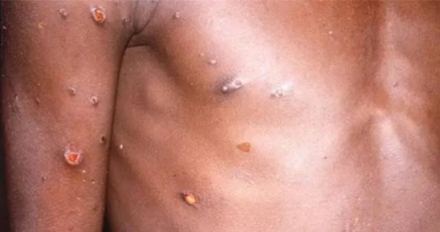 How many monkeypox cases did WHO detect in June?