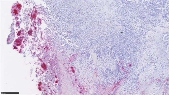 Microbiota metstasis  1