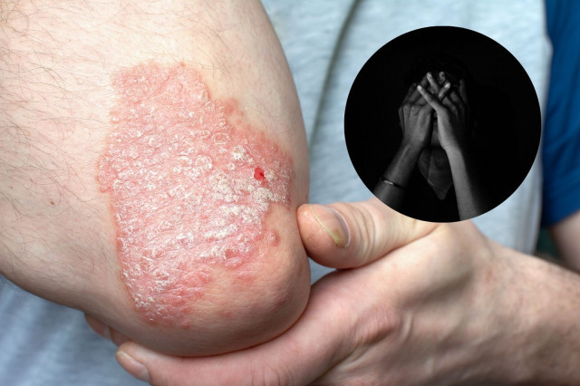 Psoriasis 1