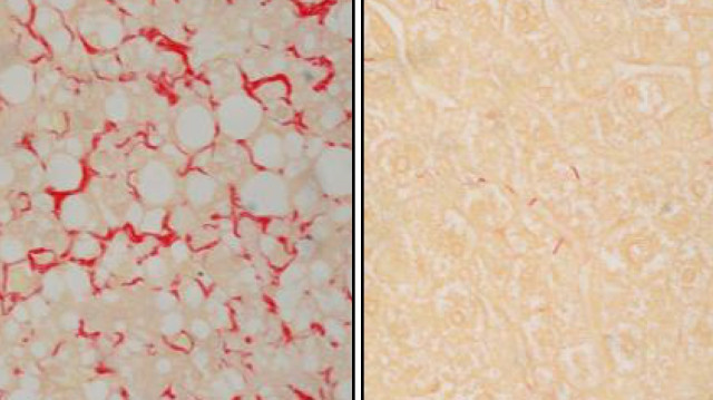 EuropaPress 6338388 tejido derivado musculo fibrosis hepatico izquierda despues tratamiento