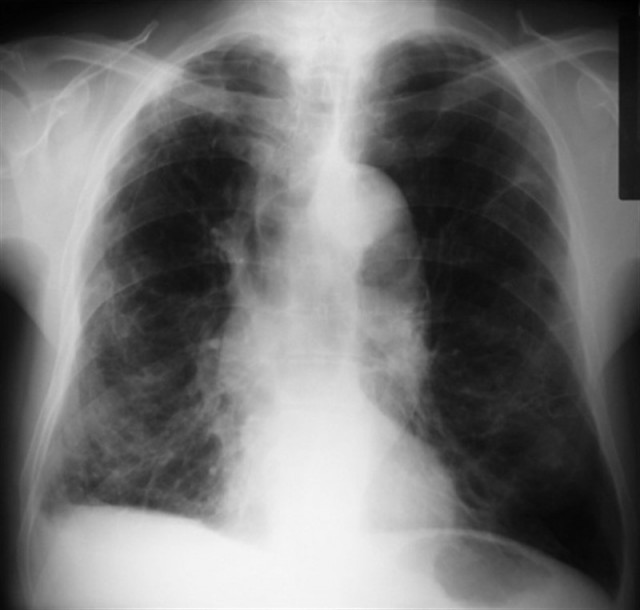 Pulmones 1