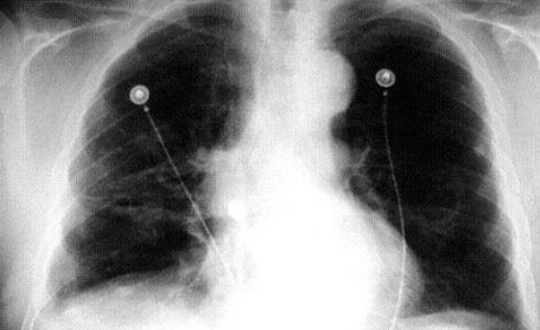 9Radiografía de càncer de pulmó