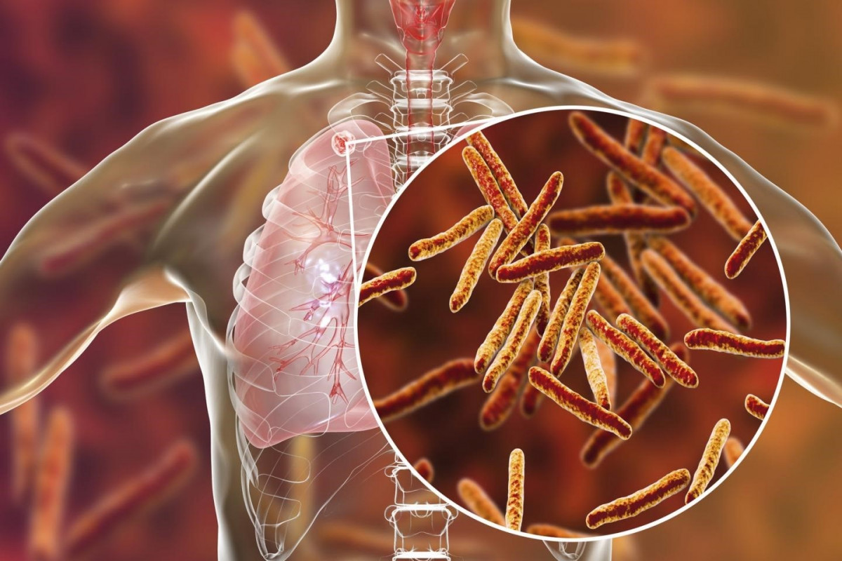 Arxiu - La tuberculosi és una infecció bacteriana causada per un germen anomenat Mycobacterium tuberculosi, que sol atacar els pulmons, però pot també danyar altres parts de el cos.